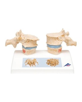 Osteoporoz Modeli
