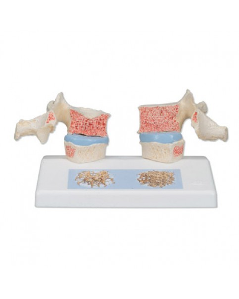 Osteoporoz Modeli