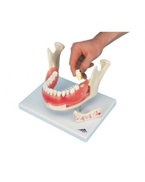 Diş Hastalıkları Modeli, 21 Parçalı, 2 Kat Büyütülmüş