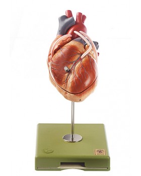 Bypass Damarları ile Kalp Modeli (Aortik Koroner Venöz Bypass)