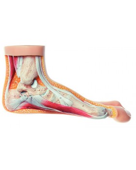 Hallux Valgus Model