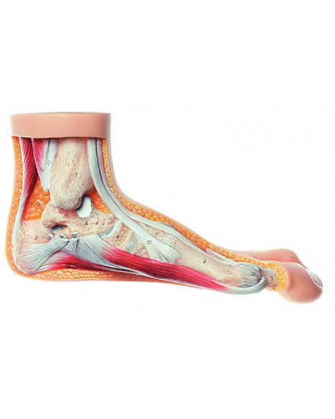 Hallux Valgus Model